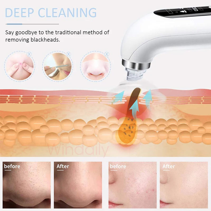 2025 Blackhead Remover Vacuum – Electric Pore Cleaner USB Rechargeable ✨
