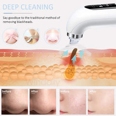 2025 Blackhead Remover Vacuum – Electric Pore Cleaner USB Rechargeable ✨