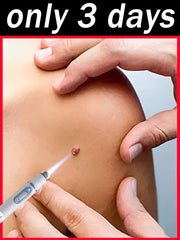 1st Gen Wart Repair Root – Fast & Effective Treatment